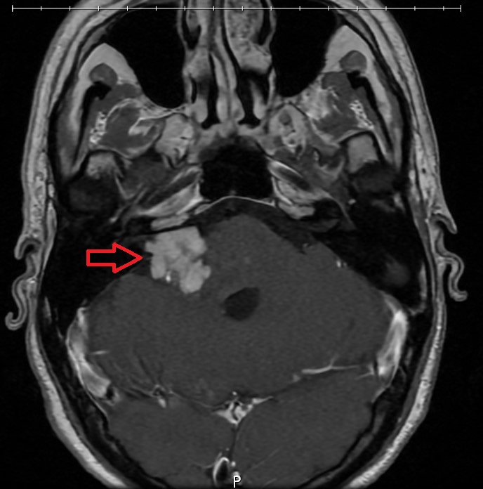 Image de diagnostic médical montrant une flèche rouge pointant vers une masse blanche dans un cerveau.